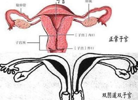 带你了解什么是纵膈子宫，别再和双子宫搞混了