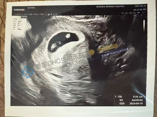 泰国DHC好孕档案0827：从4次流产到听见心跳