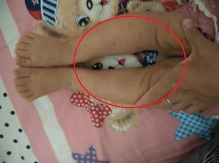宝宝罗圈腿怎么矫正？宝宝罗圈腿最佳矫正方法