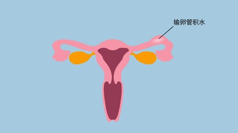 输卵管积水能自然怀孕吗？输卵管积水如何怀孕？