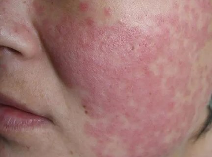 儿童红斑狼疮早期有什么症状？儿童红斑狼疮早期10个征兆