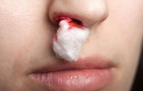 右鼻出血是什么原因引起的？右鼻出血警惕四种原因