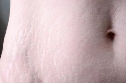 妊娠纹是什么原因引起的？避免妊娠纹的方法与技巧
