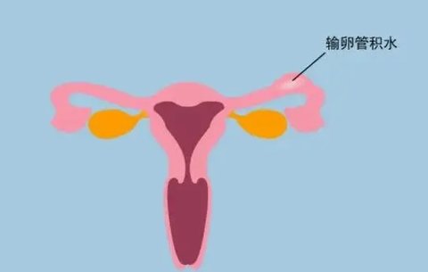只有一侧输卵管还能正常怀孕吗？少一根输卵管的影响