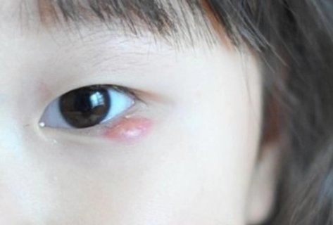 麦粒肿偏方简单有效？家庭疗法与自然缓解方法