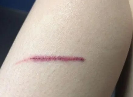 擦伤的伤口怎么样能快速恢复：家庭护理指南