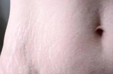 妊娠纹好几年了怎么淡化去除？多年的妊娠纹去除最好的办法