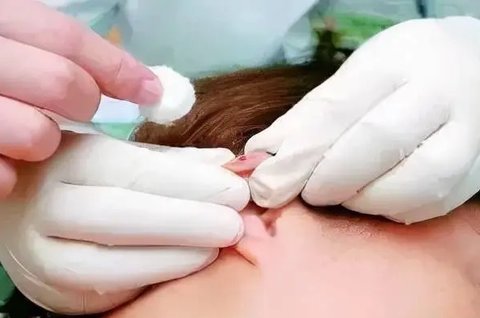 耳尖放血可以治疗失眠吗？耳尖放血的作用与功效