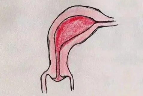 单角子宫能正常生育吗？单角子宫对怀孕的影响