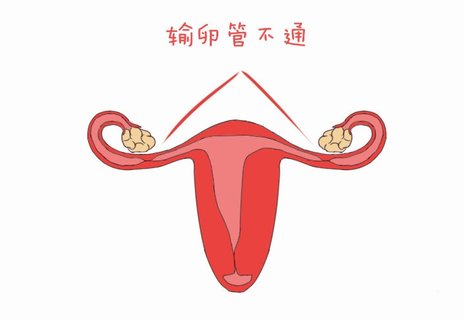 输卵管极不通畅严重吗？输卵管极不通畅可以怀孕吗？