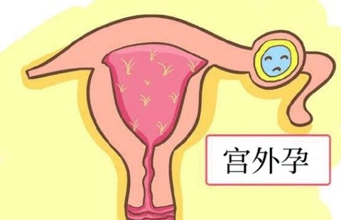 做试管会出现宫外孕吗？试管婴儿宫外孕的原因