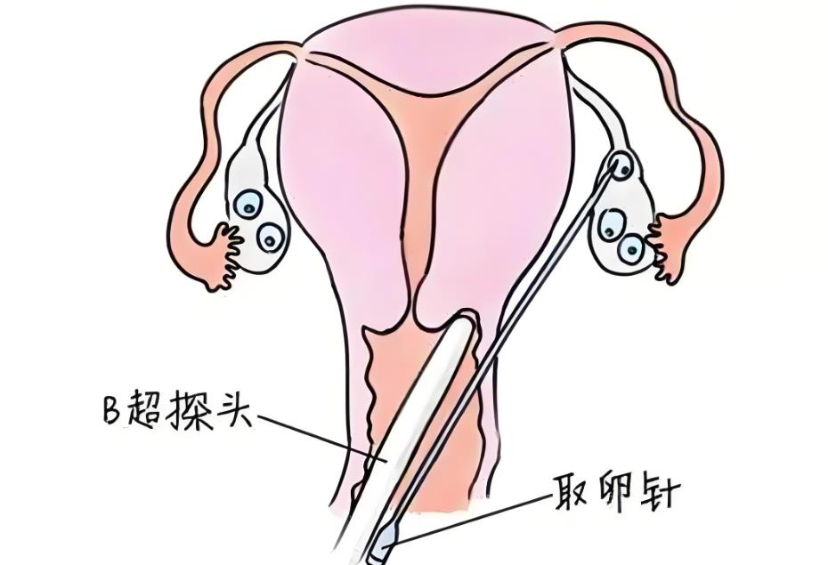 试管取卵针穿过子宫有影响吗,试管取卵针会对子宫有伤害吗