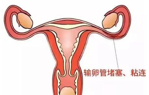 输卵管粘连对试管有影响吗？输卵管粘连与试管婴儿