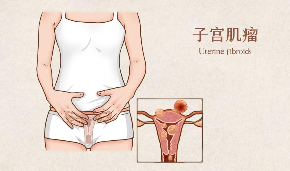 子宫肌瘤能做试管吗有影响吗