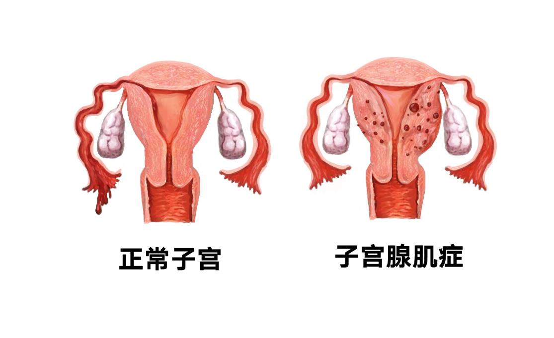 肌腺症
