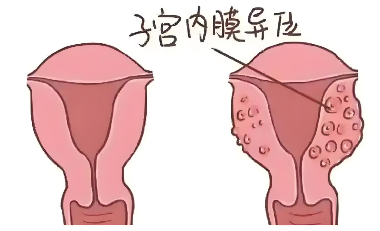 子宫内膜异位