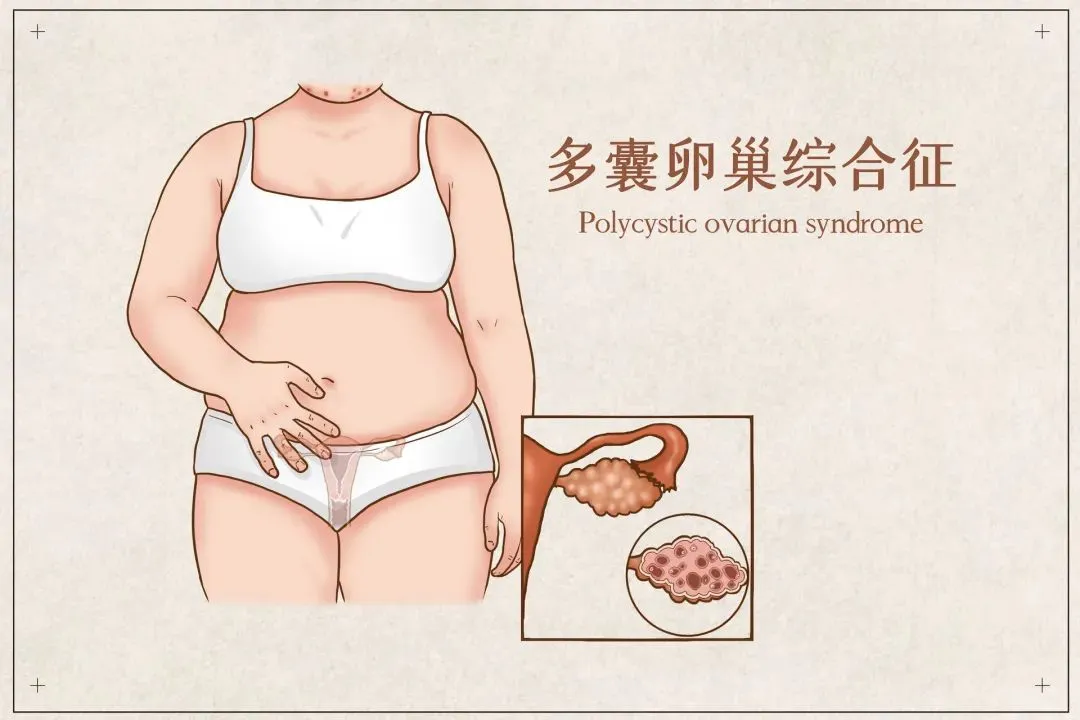 得了多囊卵巢综合征该怎么吃？附医学营养治疗方案！